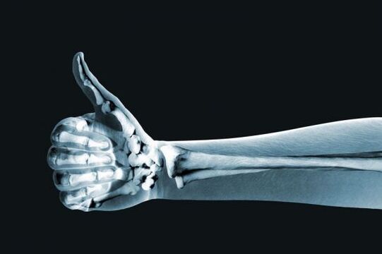 Рентгенова снимка за диагностициране на болка в ставите на пръстите
