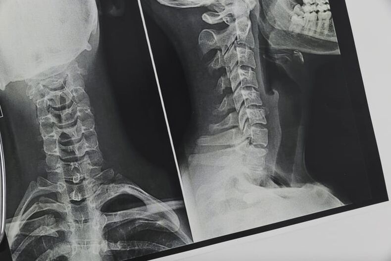 Рентгенова снимка на шийните прешлени, засегнати от остеохондроза