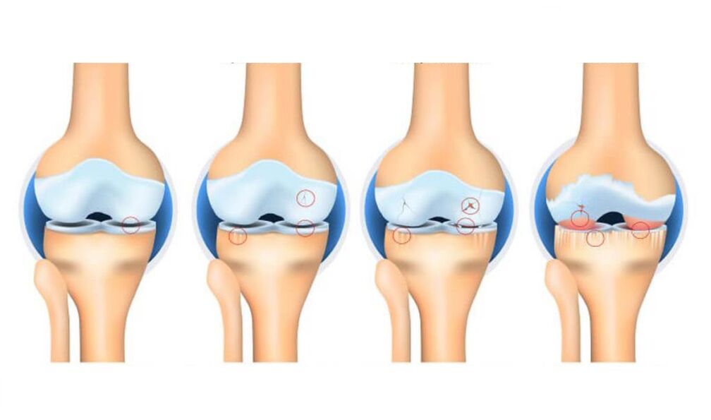 етапи на артроза на колянната става
