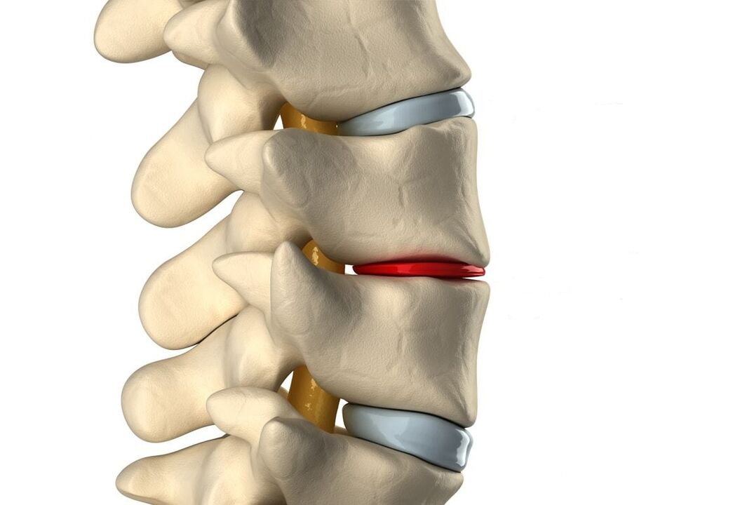 Здрав междупрешленен диск (син) и увреден поради гръдна остеохондроза (червен)
