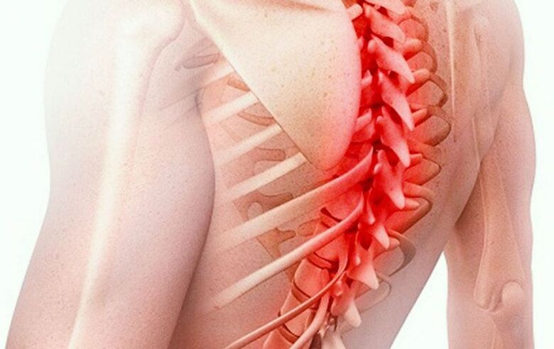 остеохондроза на гръдния кош