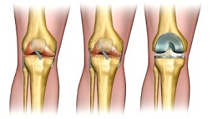 ендопротезиране за артроза на колянната става